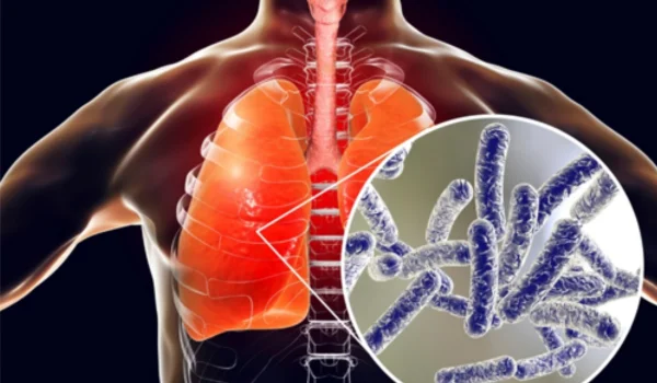 Legionnaires’ Disease